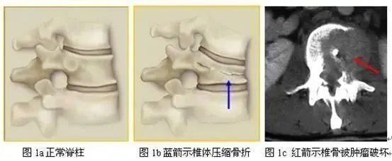 椎體成形術(shù)，助力耄耋老人重獲健康——鳳凰醫(yī)院骨科常規(guī)開展椎體成形手術(shù)