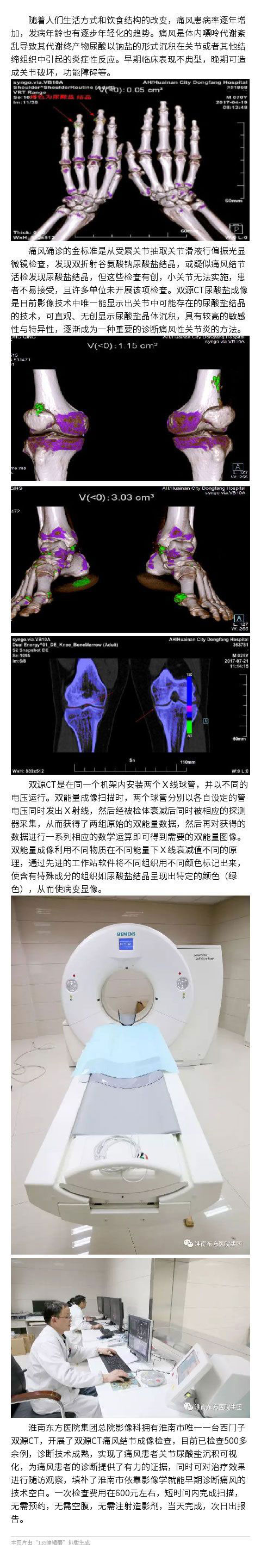 雙源CT火眼金睛 洞察秋毫痛風(fēng)元兇——雙能量CT成像診斷痛風(fēng)性關(guān)節(jié)炎