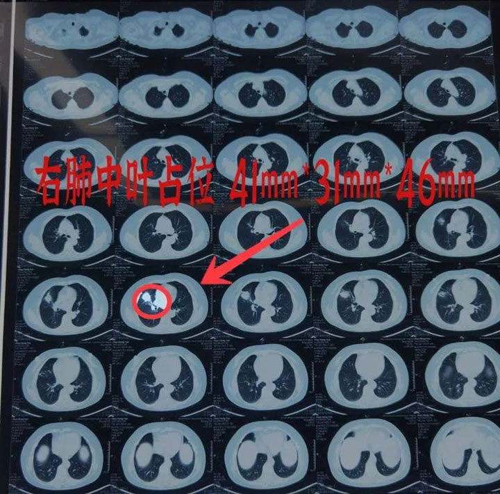 燈下妙手除惡疾 鏡內(nèi)仁心戰(zhàn)病魔——廣濟(jì)醫(yī)院順利完成首例微創(chuàng)肺癌手術(shù)